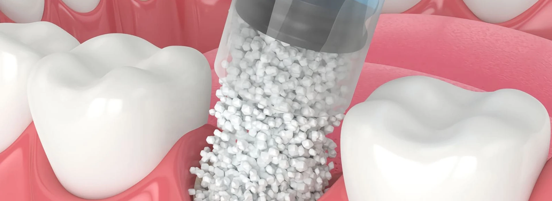 kemik tozu tedavisi 1